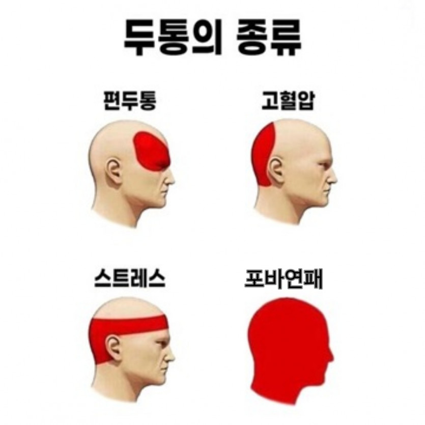 두통의 종류 짤 JJAL(0)