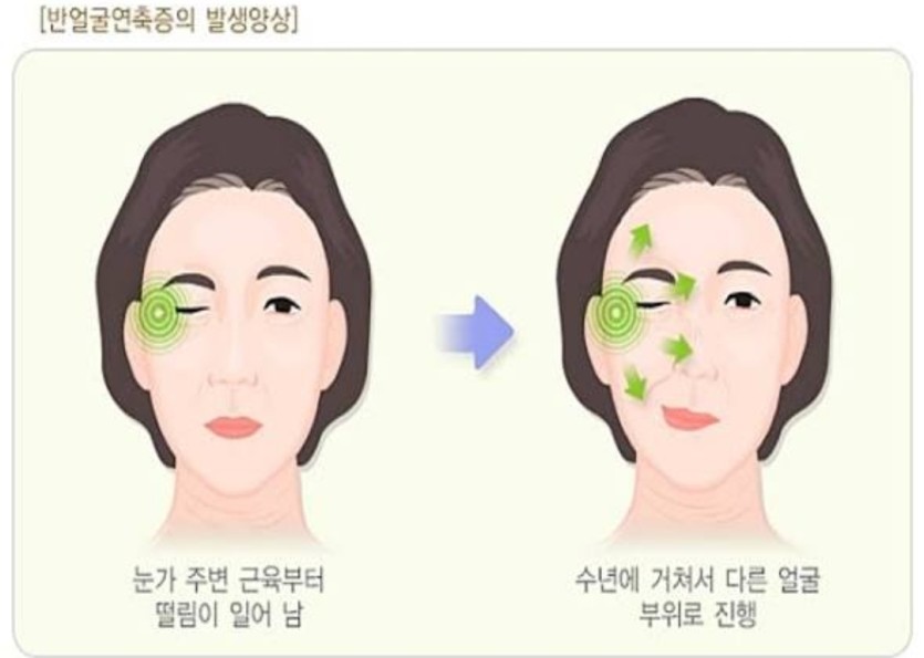 눈떨림 증상 있으신 분 계신가요(0)