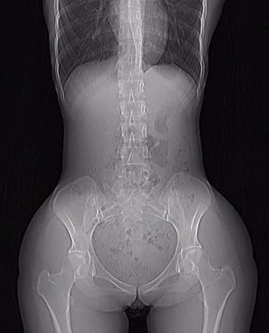 25세 여성이 갑자기 복통을 호소하며 응급실(0)